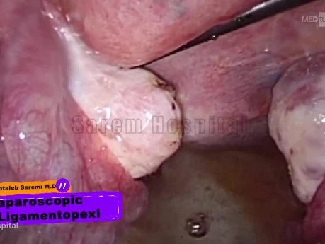 Laparoscopic Ligamentopexy