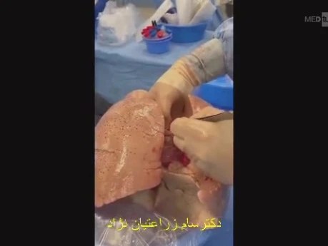 Simultaneous Multiple Thoracic Organs Implant in a Complex Manner 