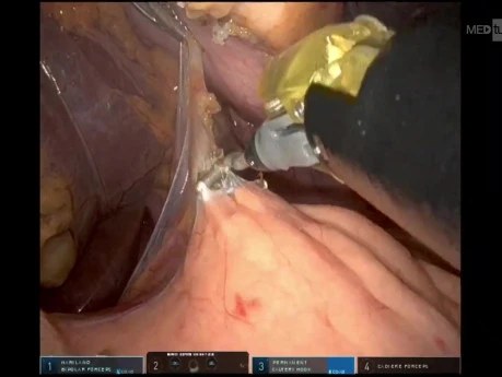 Robotic Spleen Preserving Distal Pancreatectomy - Full-length Video