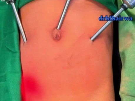 Laparoscopic Congenital Inguinal Hernia Surgery (ITP Repair) in a 5 Year Old Kid