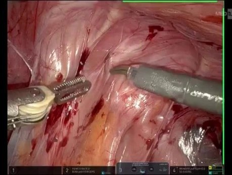 Robotic Repair of Complex Concomitant Parastomal and Midline Incisional Hernias: A Combined Keyhole–Sugarbaker and IPOM Approach Using Titanized Meshes