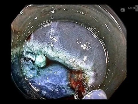 Dual-modality Approach To Active Post-polypectomy Bleeding Control