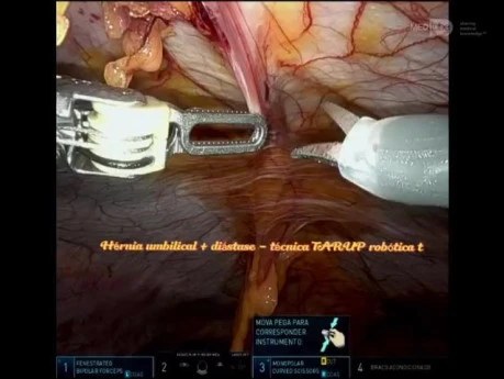 Umbilical Hernia and Diastasis Repair – TARUP technique