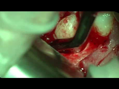 Laser-Assisted Third Molar Extraction with Dental Microsurgery