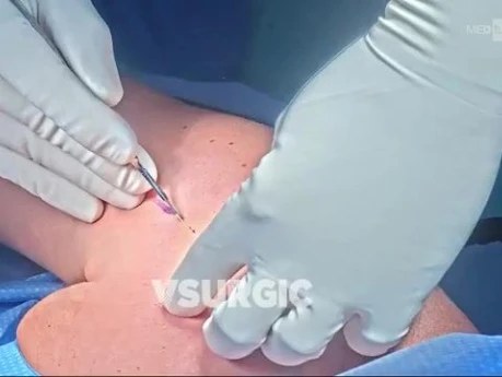 Shoulder Resurfacing Hemiarthroplasty